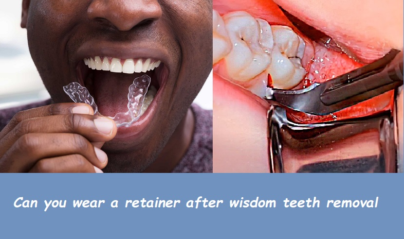 Can you wear a retainer after wisdom teeth removal