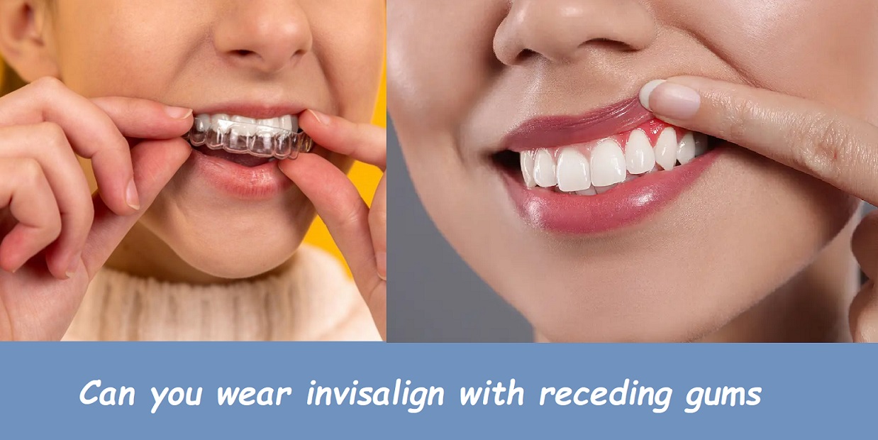 Can you wear invisalign with receding gums