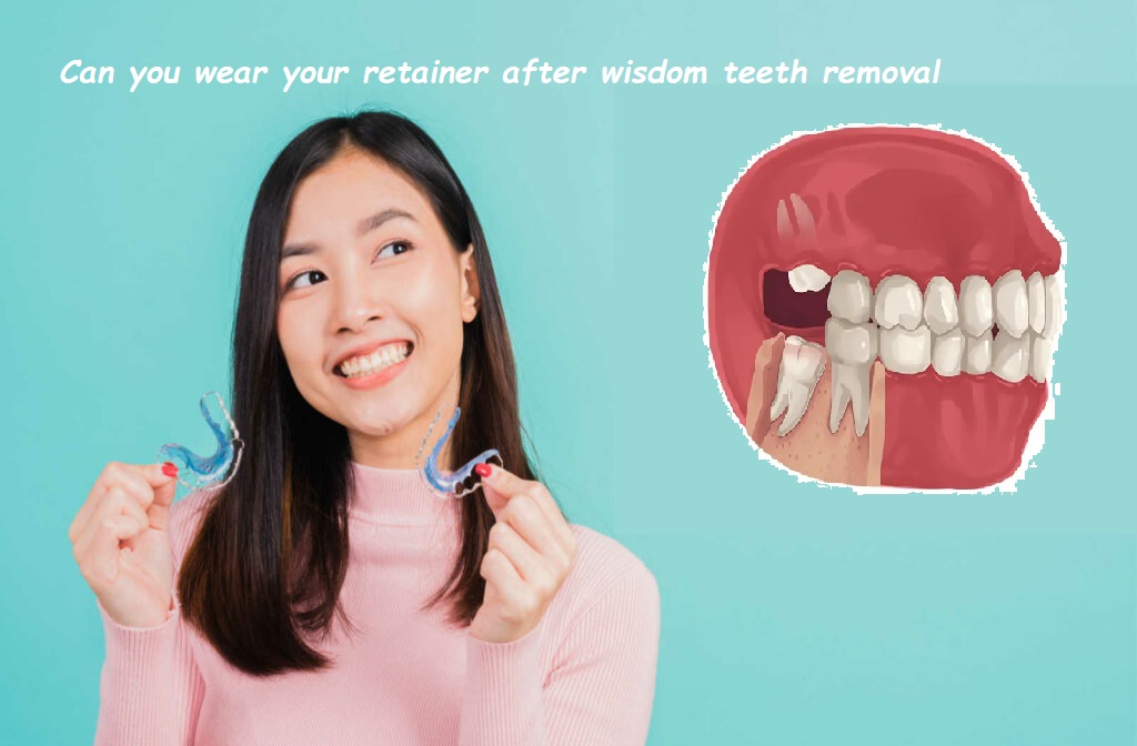 Can you wear your retainer after wisdom teeth removal