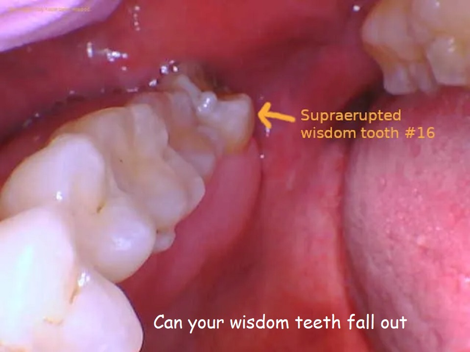 can your wisdom teeth fall out