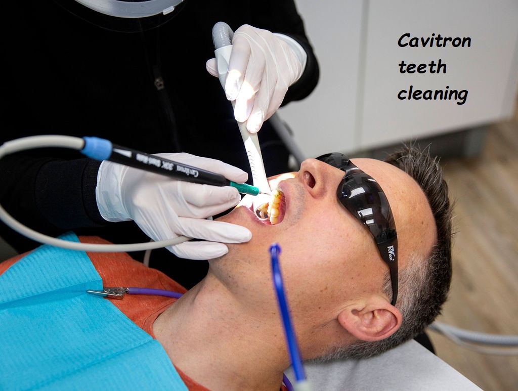 Cavitron teeth cleaning