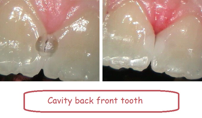 Cavity back front tooth