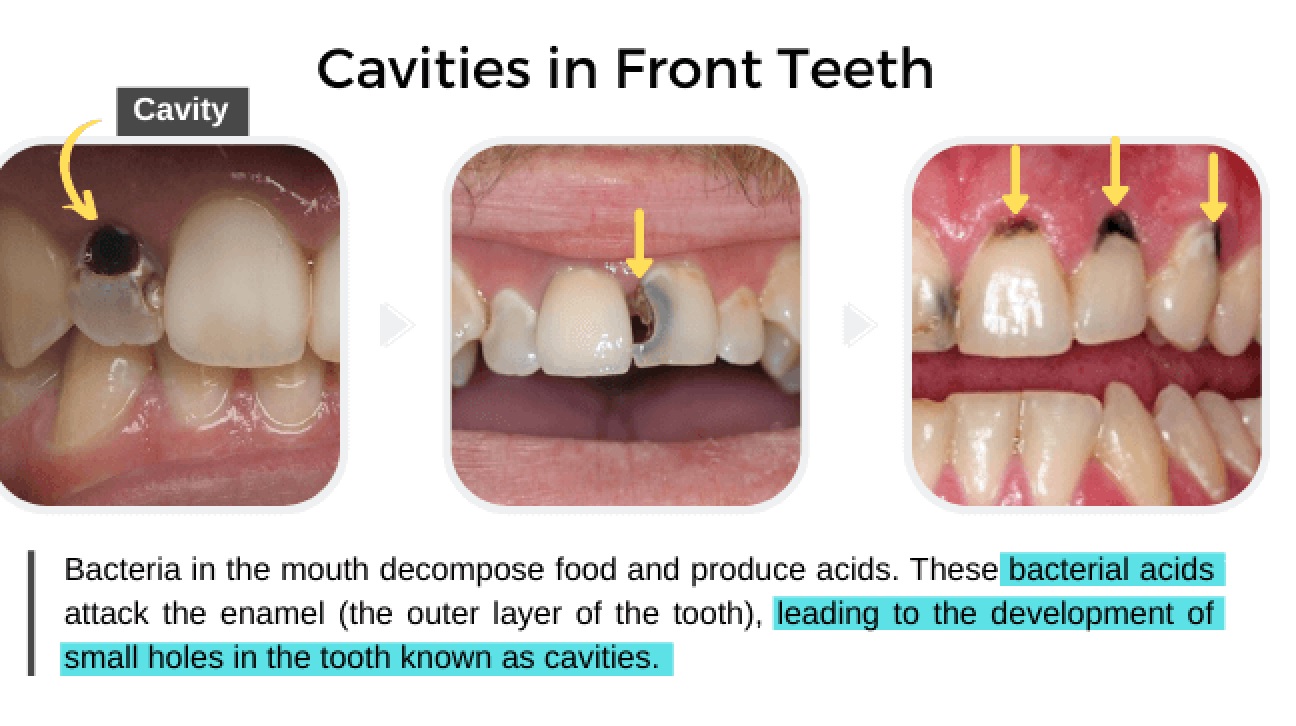 Cavity in Front Teeth: Causes, Treatment, and Prevention