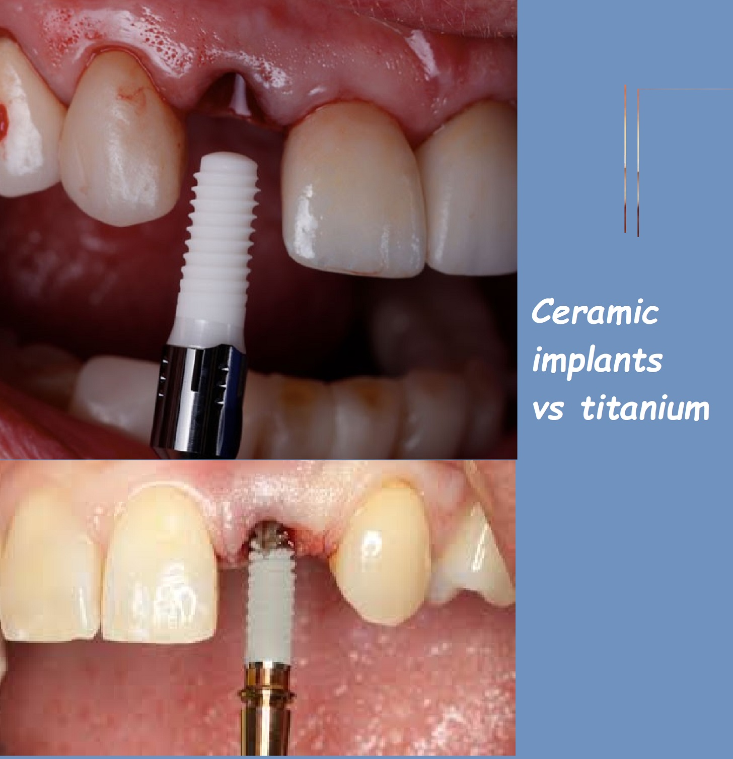 ceramic implants vs titanium