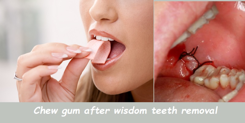 chew gum after wisdom teeth removal