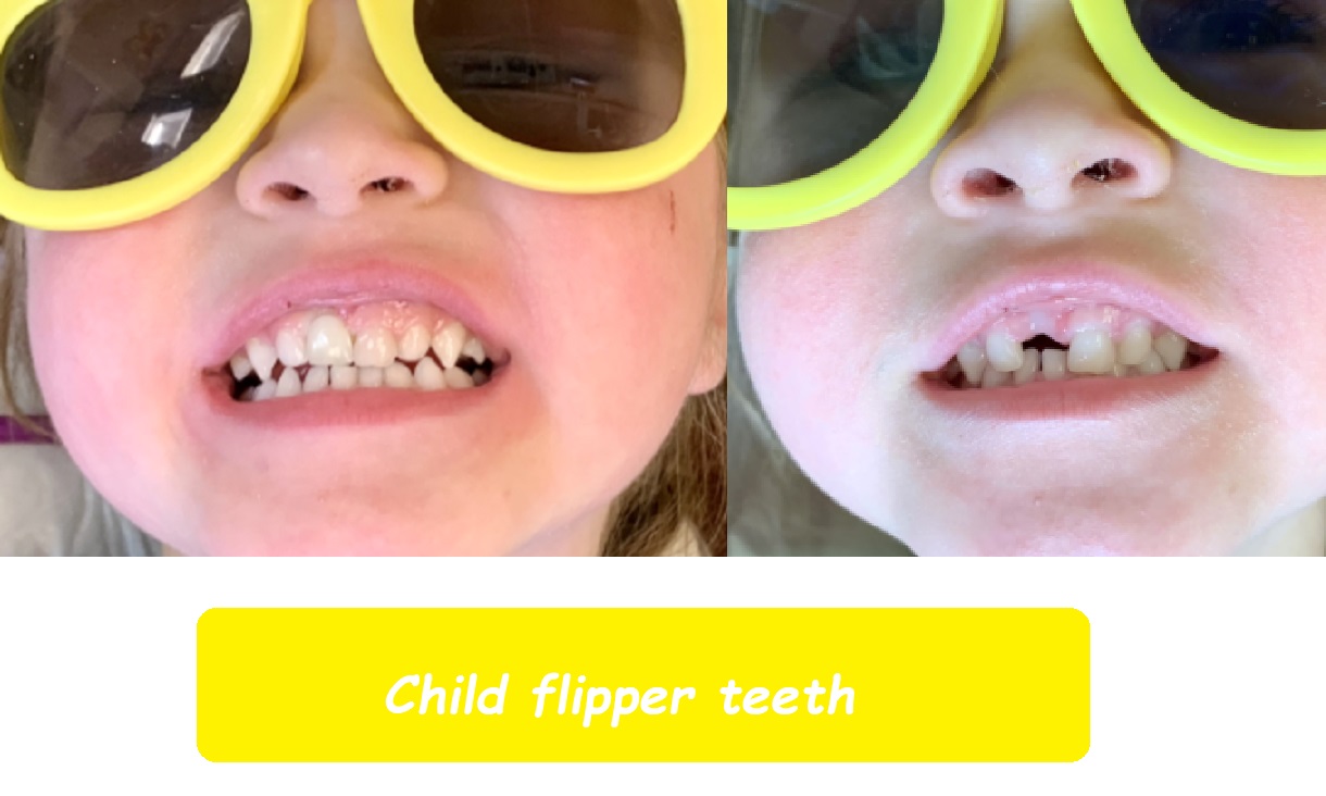 Child flipper teeth