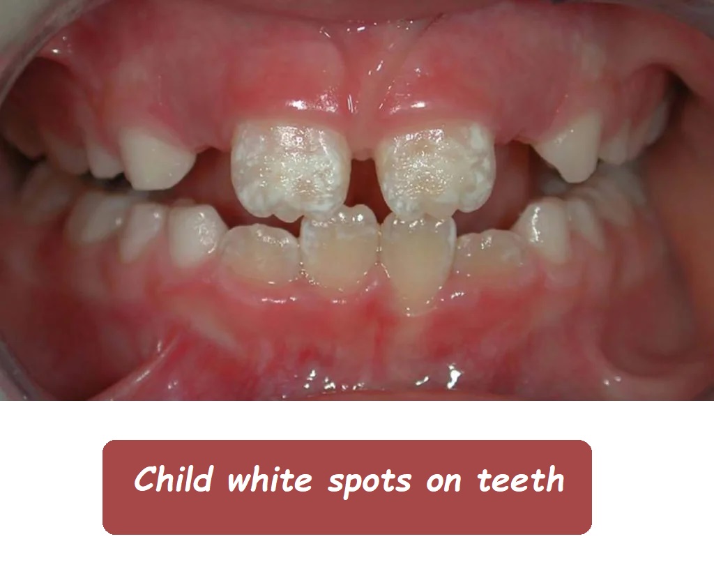 Child white spots on teeth