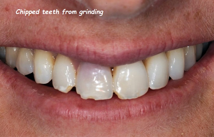 Chipped teeth from grinding