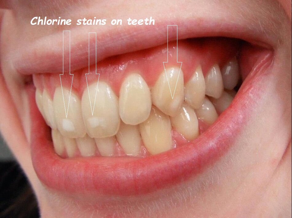 Chlorine Stains on Teeth