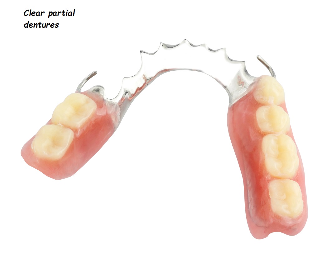 clear partial dentures