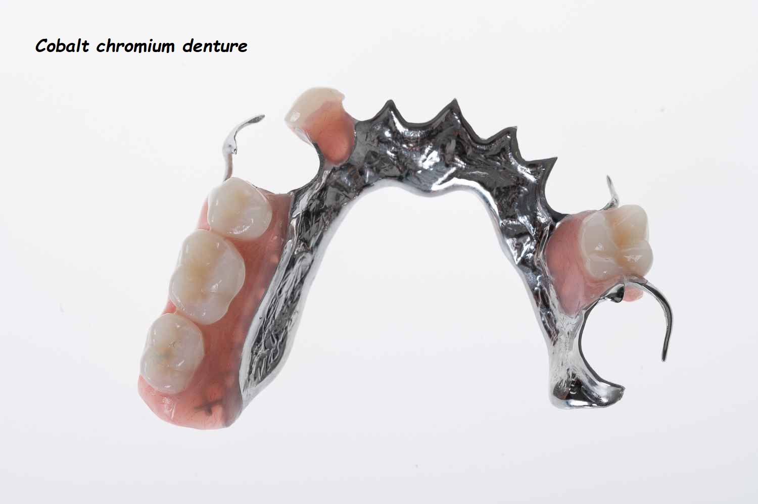 Cobalt chromium denture