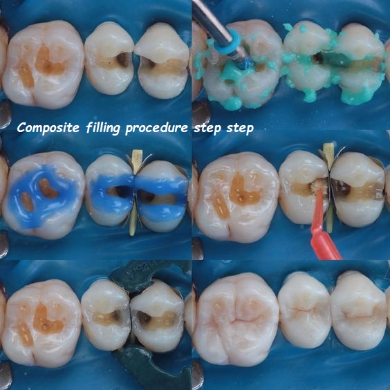 Composite filling procedure step step