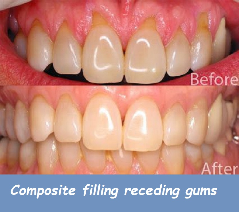 Composite filling receding gums