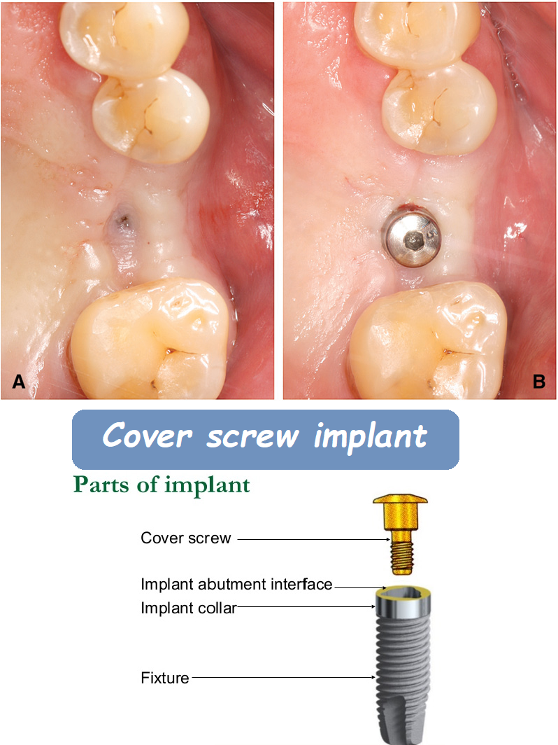 Cover screw implant