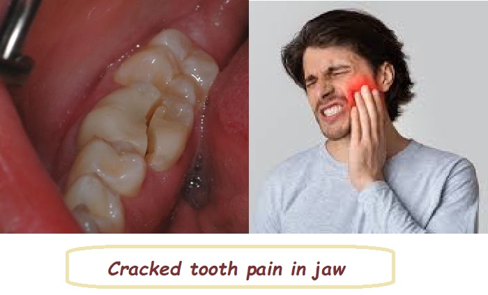 Cracked tooth pain in jaw