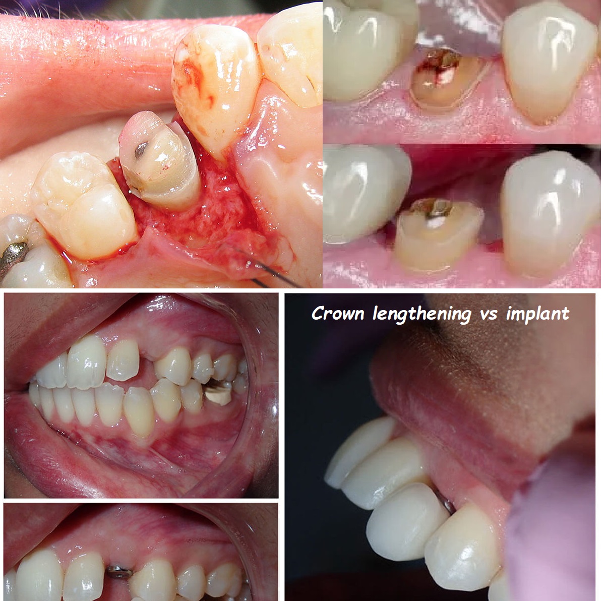 Crown lengthening vs implant