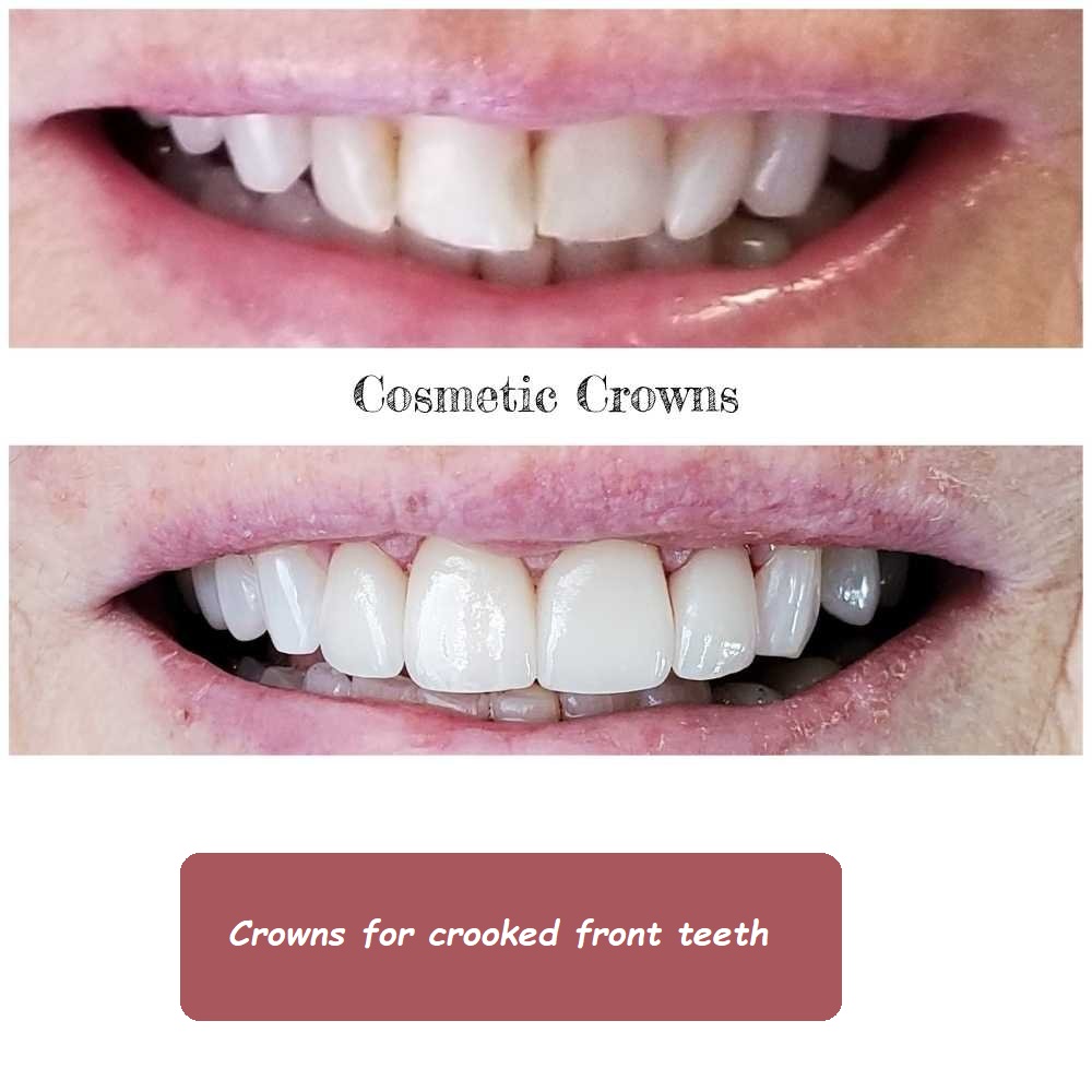 crowns for crooked front teeth