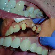 Crowns for missing teeth