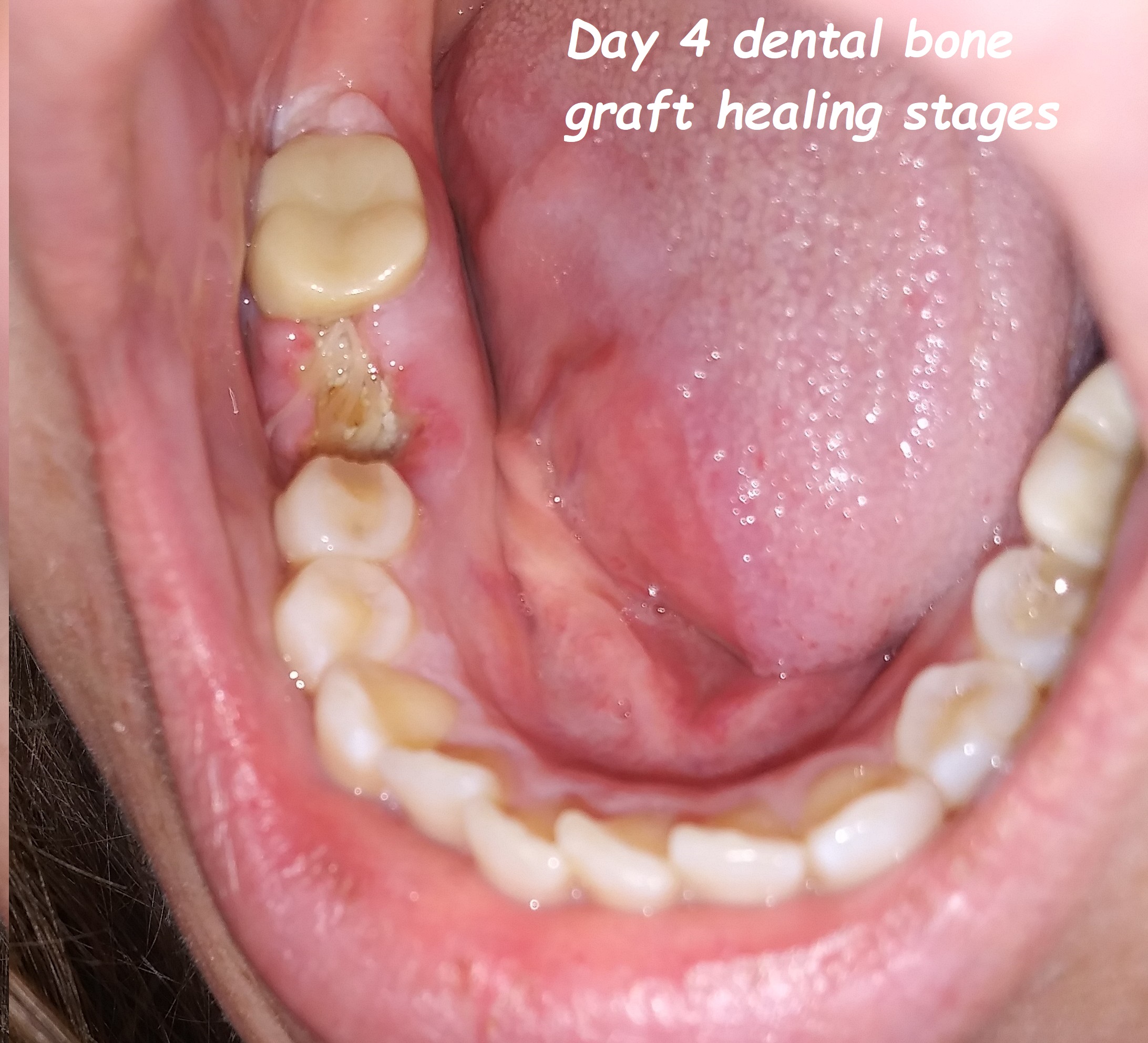 Day 4 dental bone graft healing stages