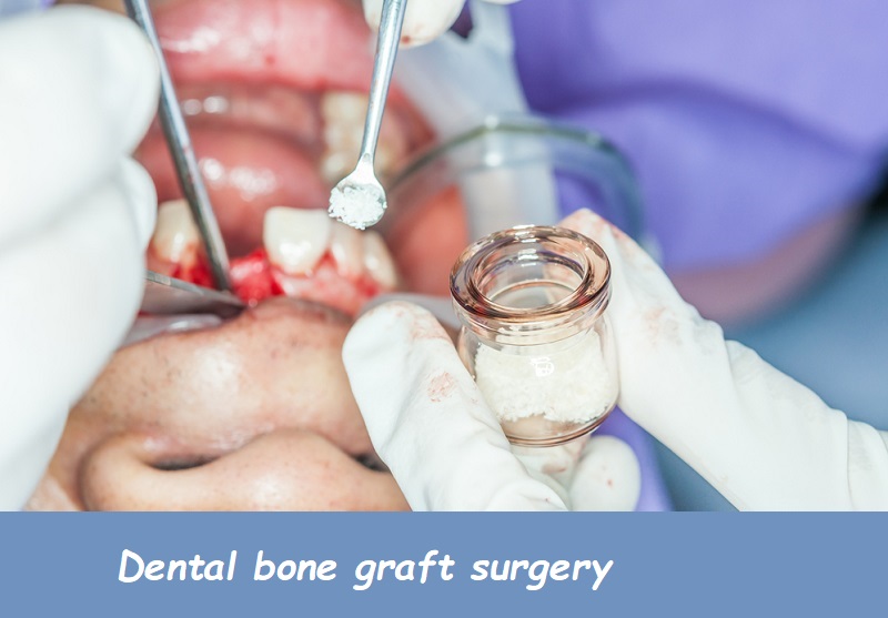 dental bone graft surgery