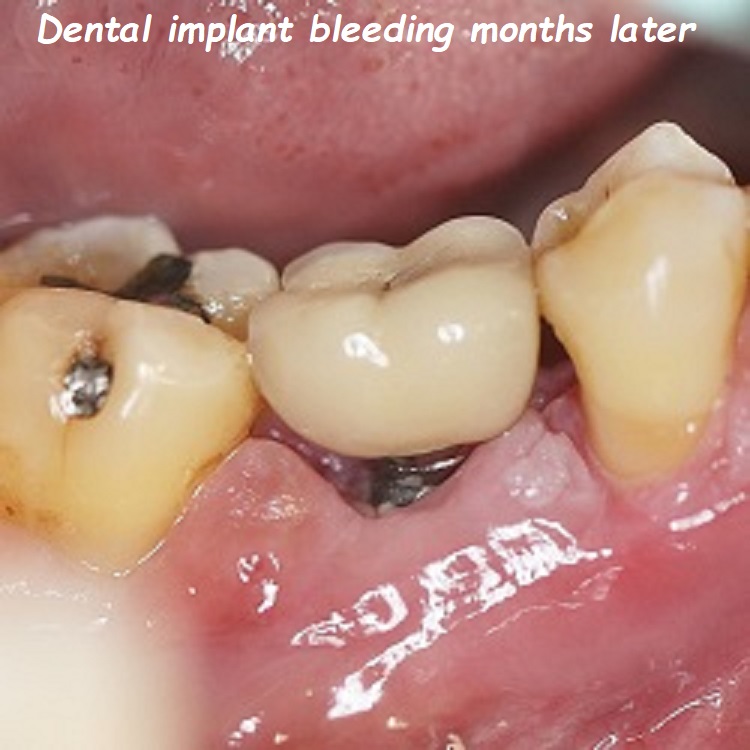 Dental implant bleeding months later