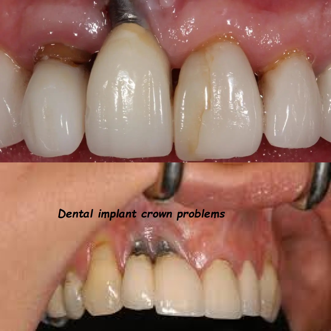 Dental implant crown problems