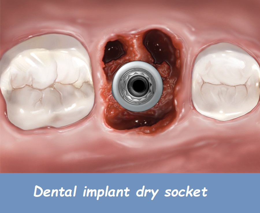 Dental implant dry socket