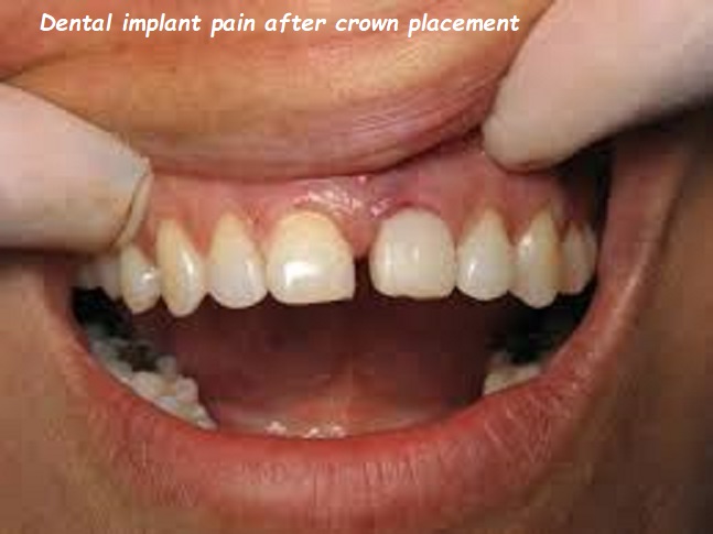 dental implant pain after crown placement