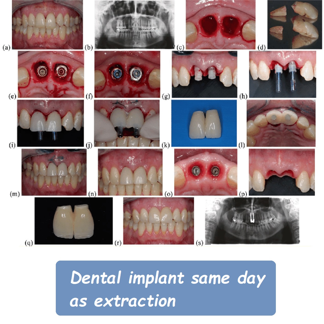 dental implant same day as extraction