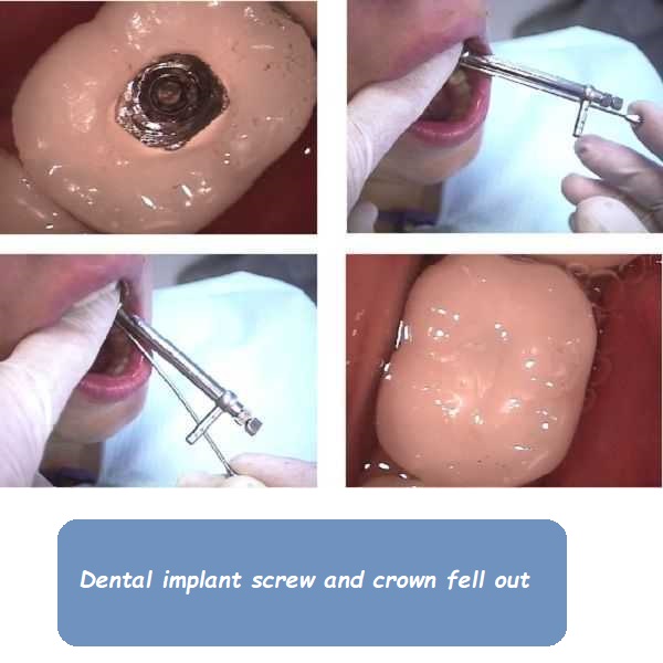 dental implant screw and crown fell out