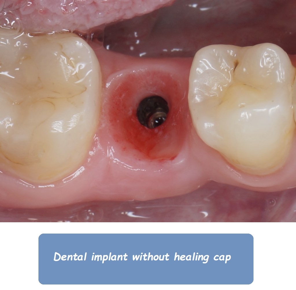 Dental implant without healing cap