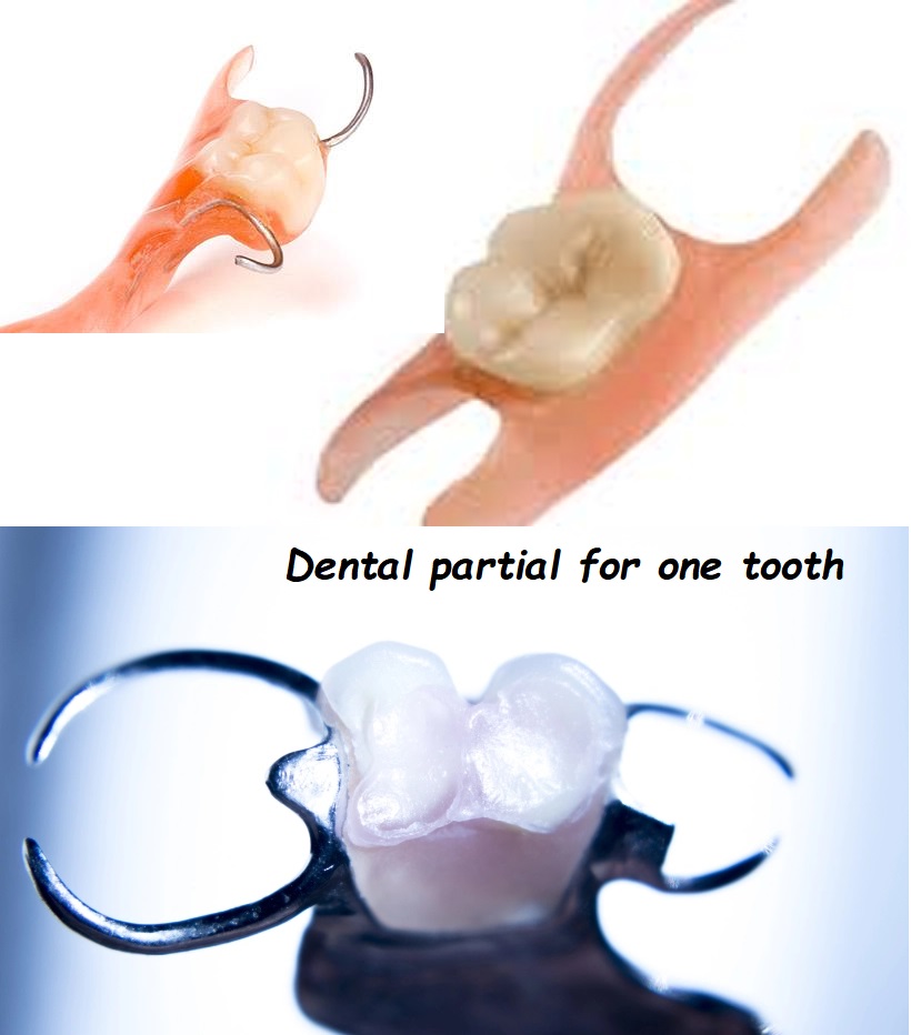 Dental partial for one tooth