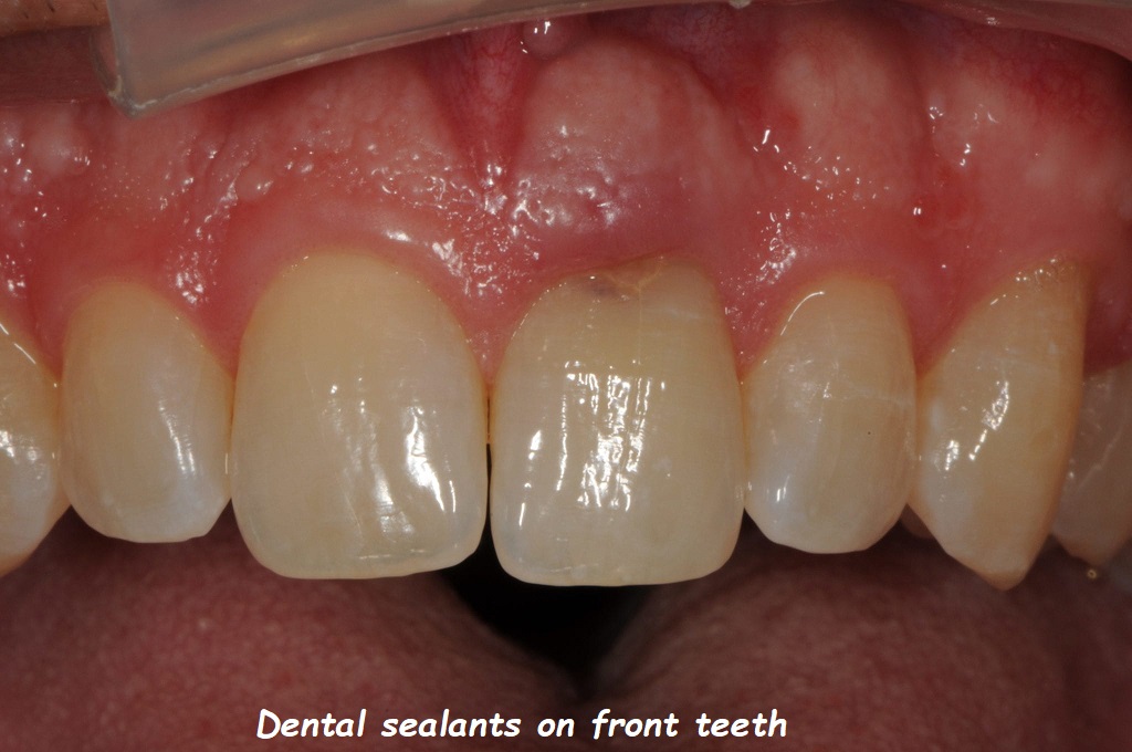 dental sealants on front teeth