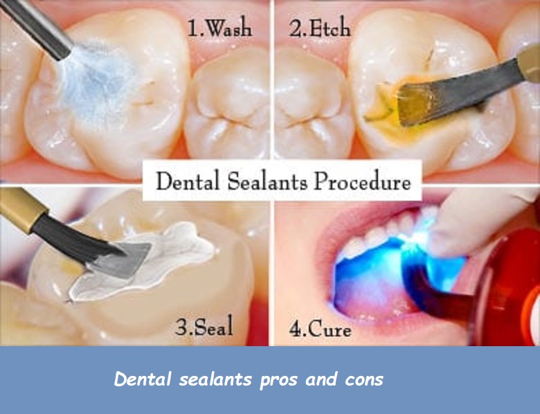 dental sealants pros and cons