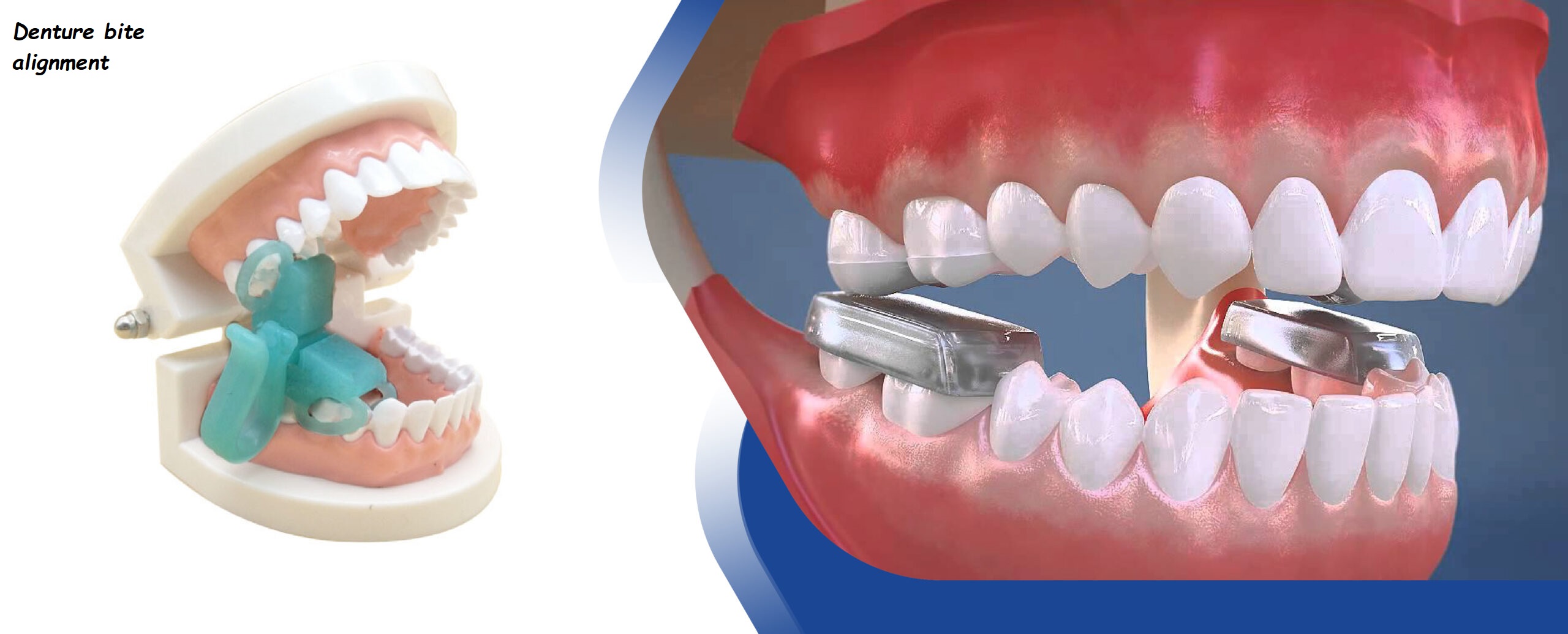 denture bite alignment