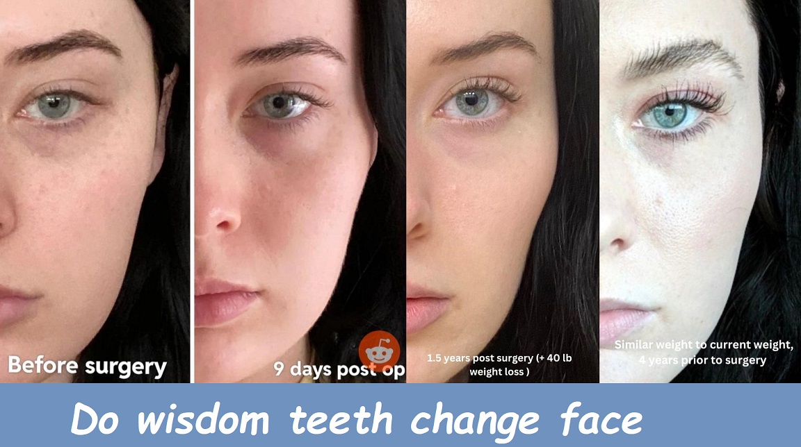 Do wisdom teeth change face shape