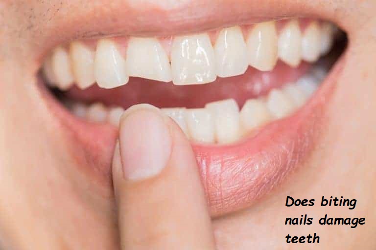 does biting nails damage teeth