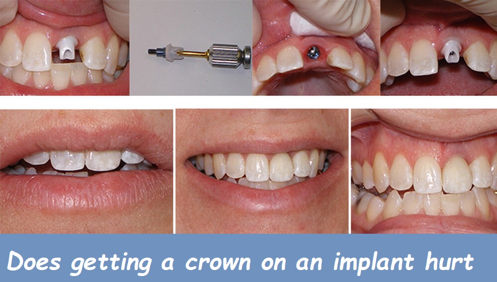 does getting a crown on an implant hurt