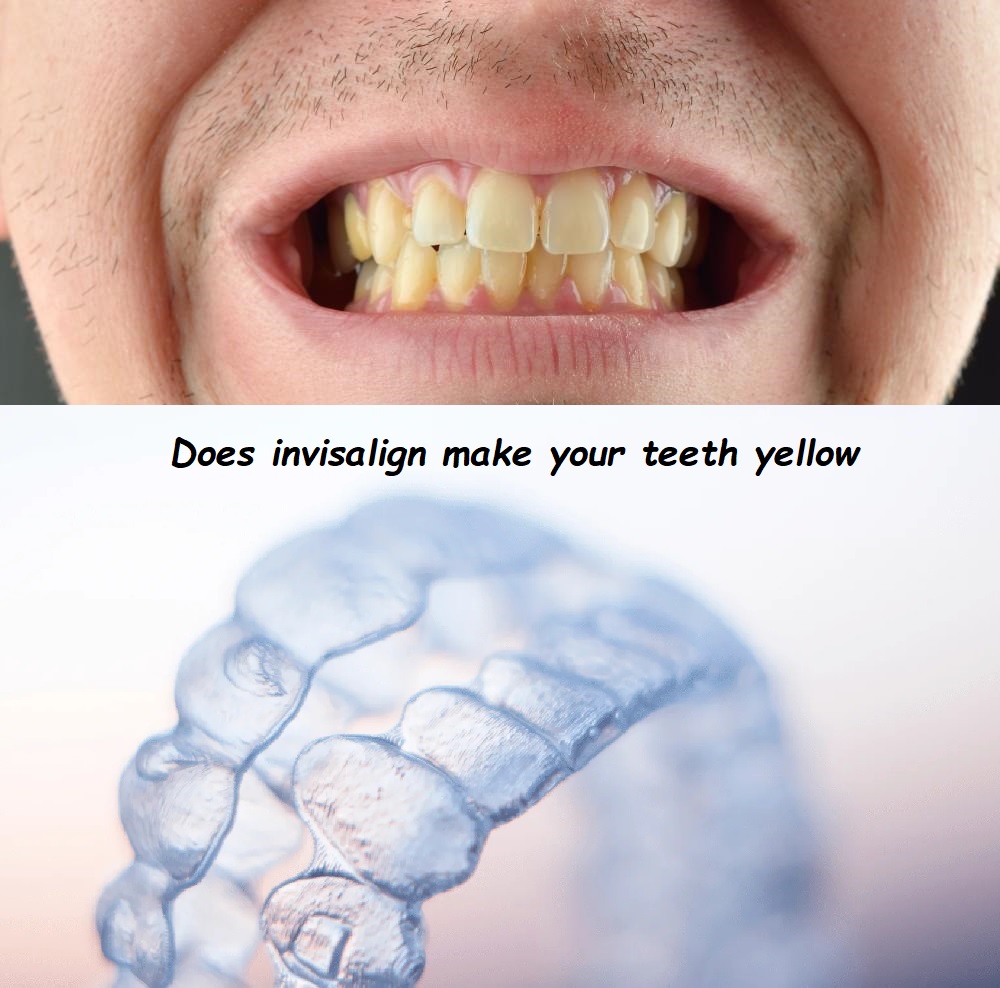 Does invisalign make your teeth yellow