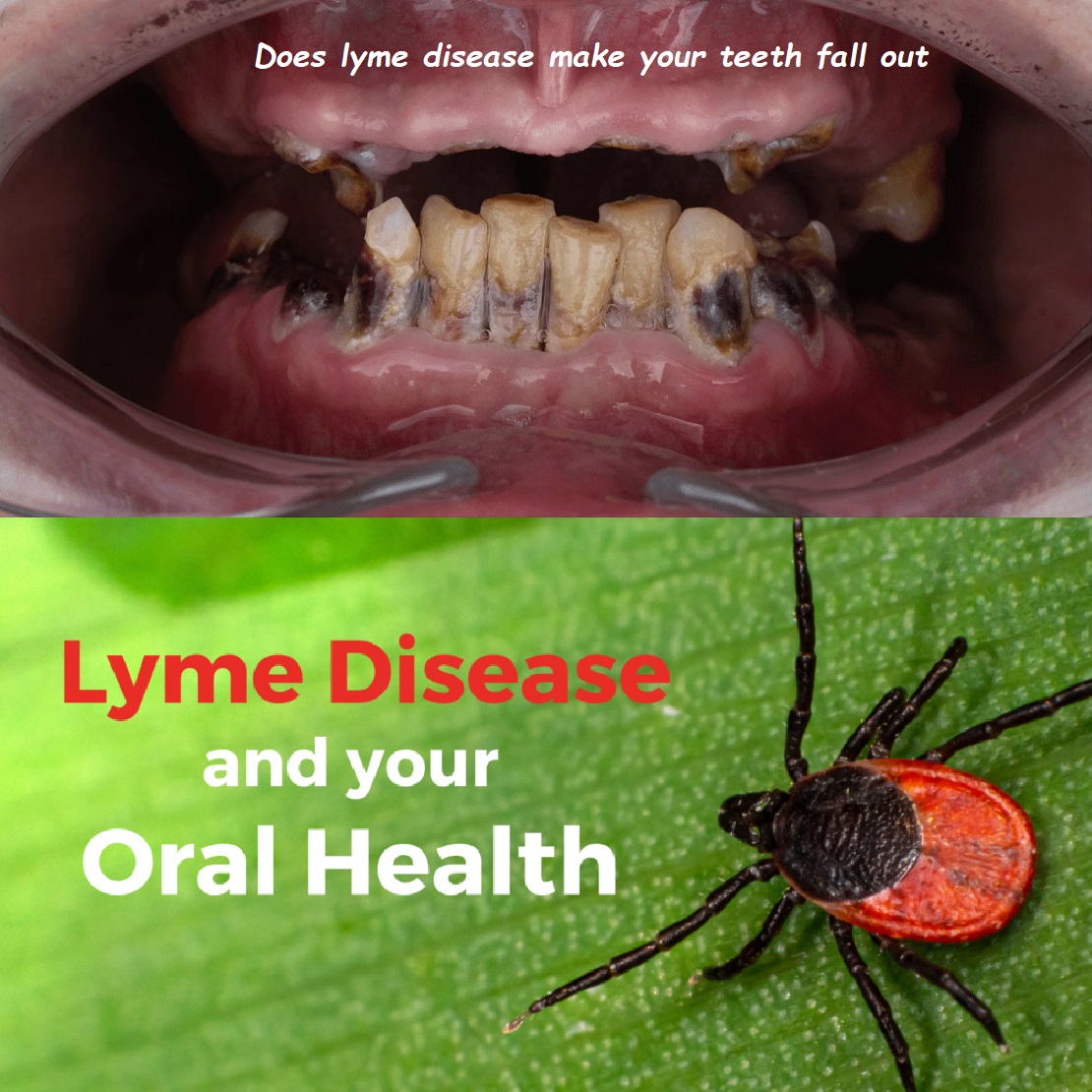 Does lyme disease make your teeth fall out