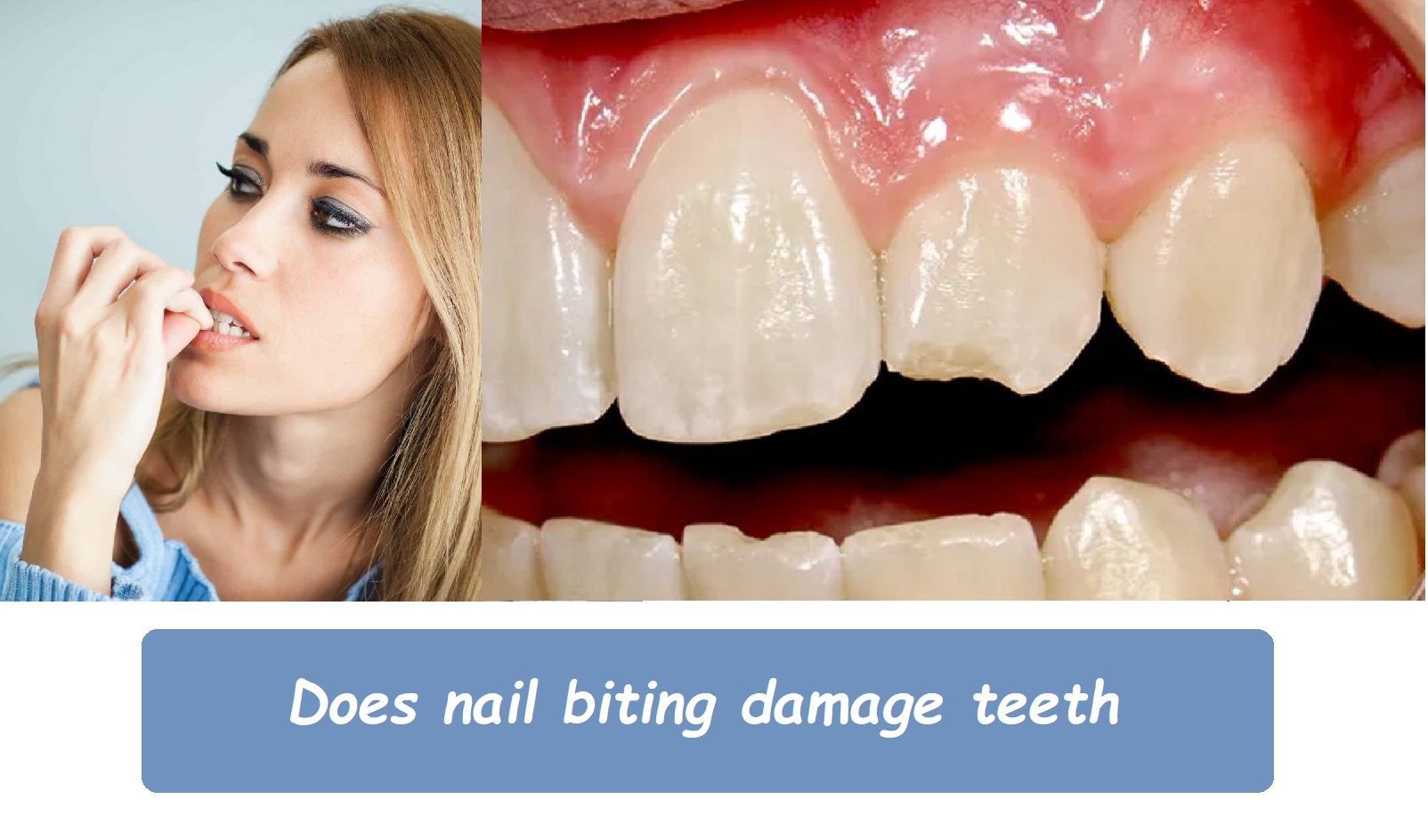 Does nail biting damage teeth