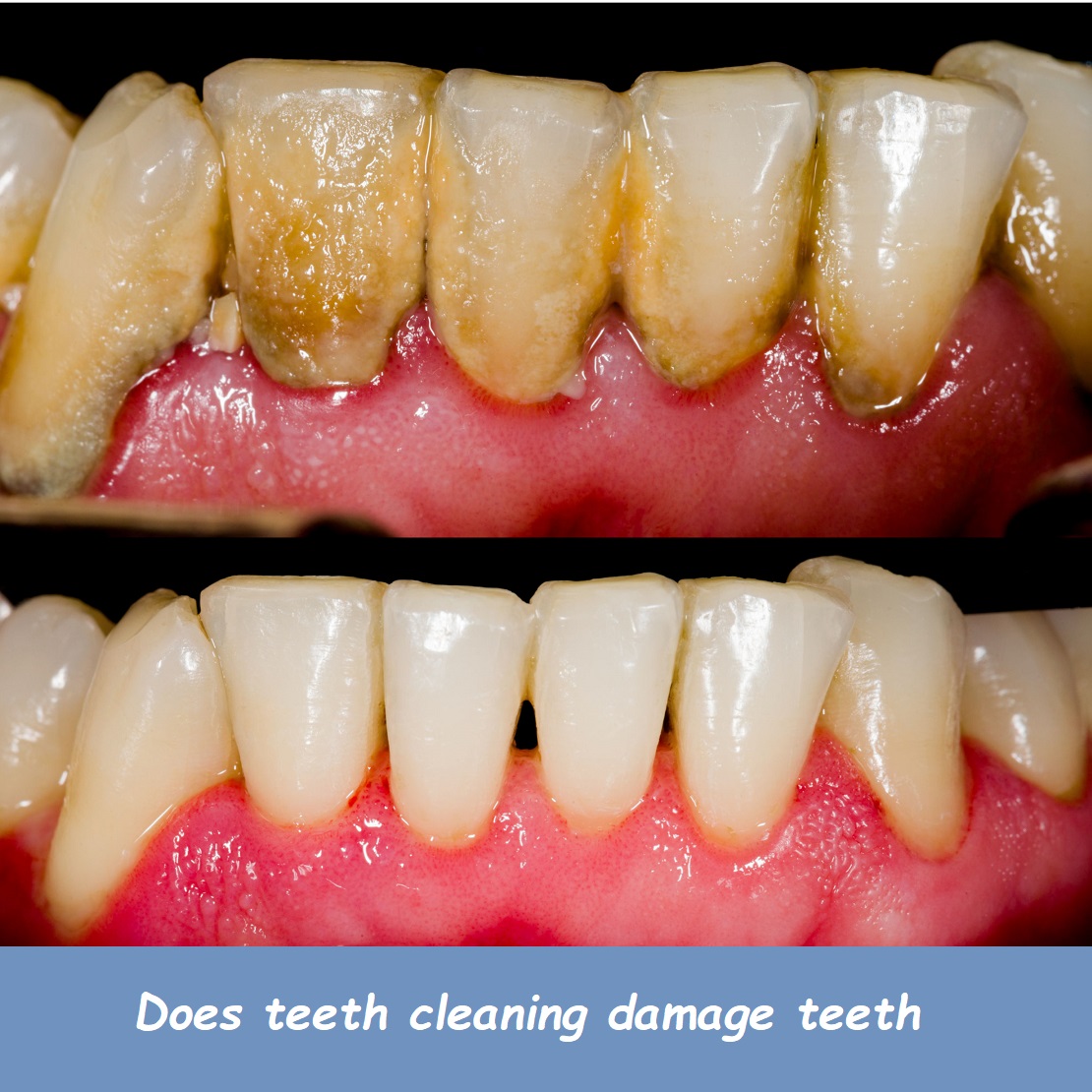 does teeth cleaning damage teeth