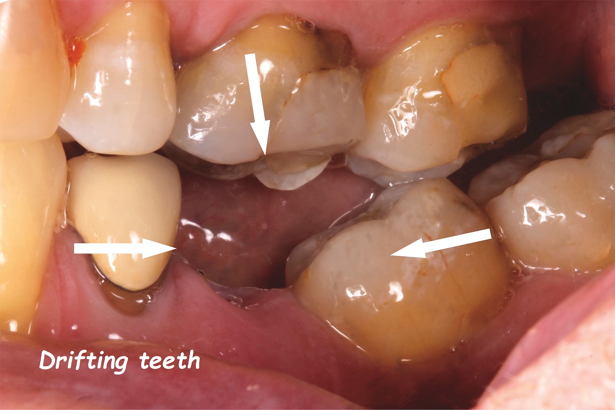 drifting teeth