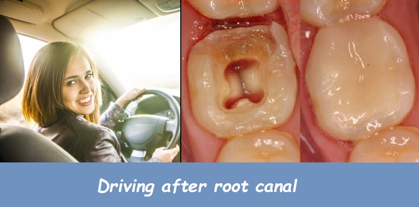 driving after root canal