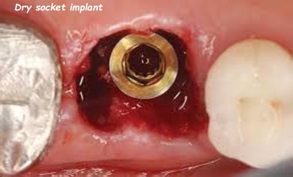 dry socket implant