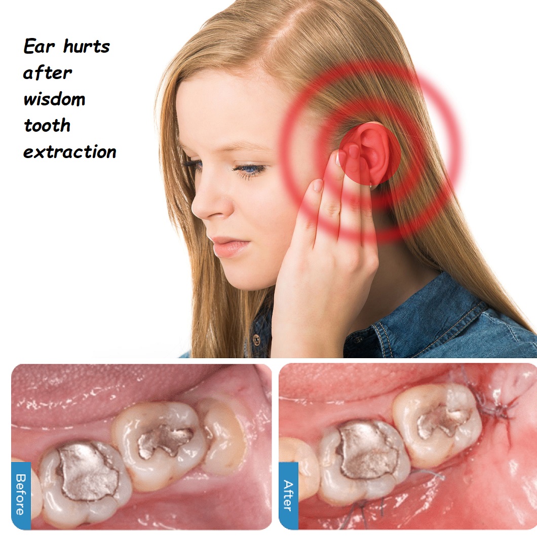 Ear hurts after wisdom tooth extraction