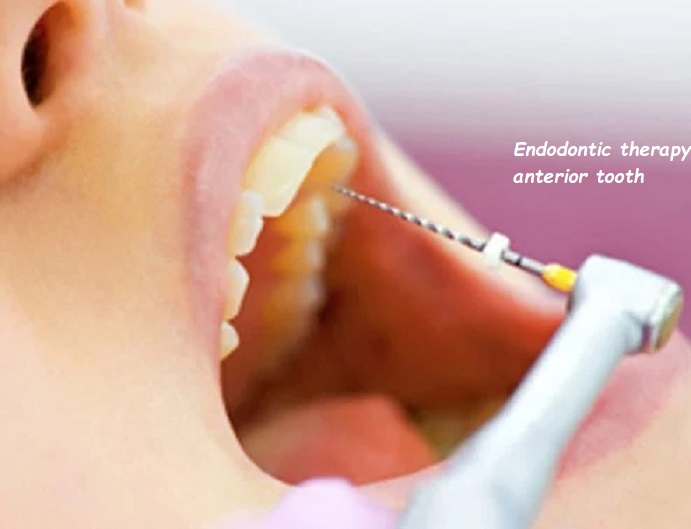 Endodontic therapy anterior tooth