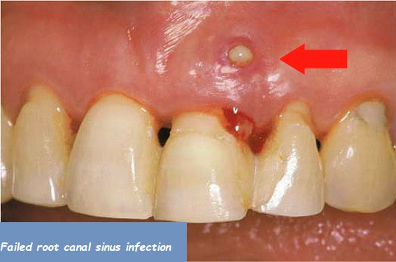 failed root canal sinus infection