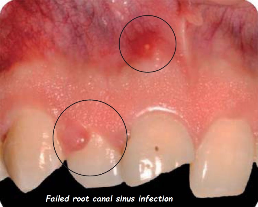 failed root canal sinus infection