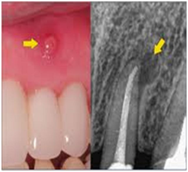 failed root canal sinus infection